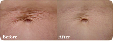 Los Angeles Laser Skin Rejuvenation